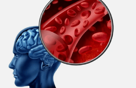 Bayyanar cututtuka na osteochondrosis na cervical spine
