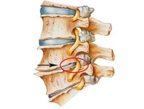 Alamu da alamu na osteochondrosis