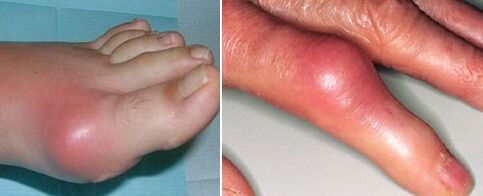 bayyanar gidajen abinci tare da amosanin gabbai