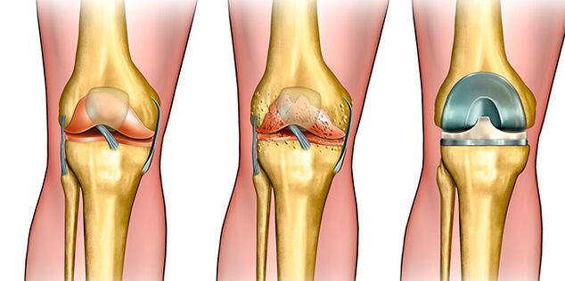 A mataki na uku na arthrosis, ana buƙatar maye gurbin gwiwa