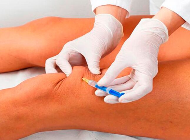 Intra-articular injections na kwayoyi don arthrosis na gwiwa gwiwa