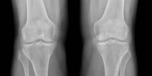 gwiwa osteoarthritis x-ray