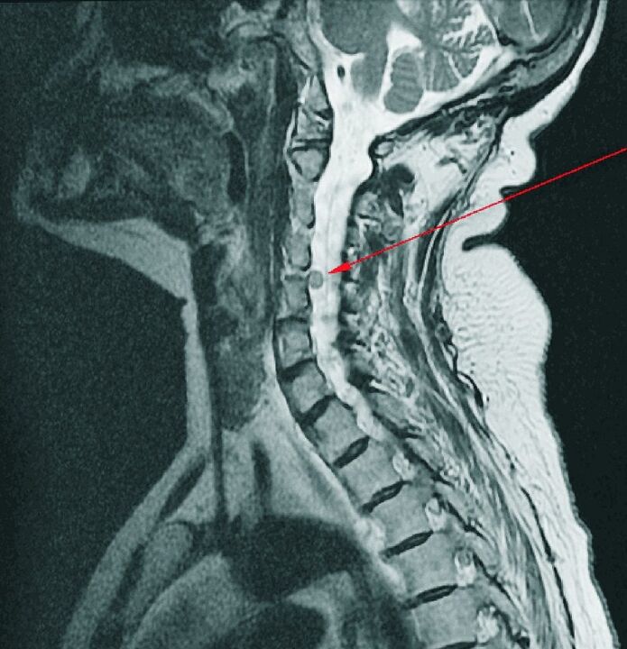 Intervertebral hernia na kashin baya na mahaifa akan MRI