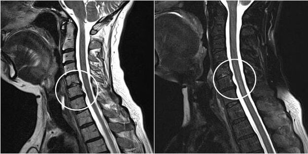 MRI na kashin baya na mahaifa tare da alamun osteochondrosis