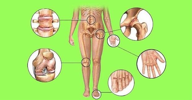 gidajen abinci da ke fama da cututtukan arthritis da arthrosis