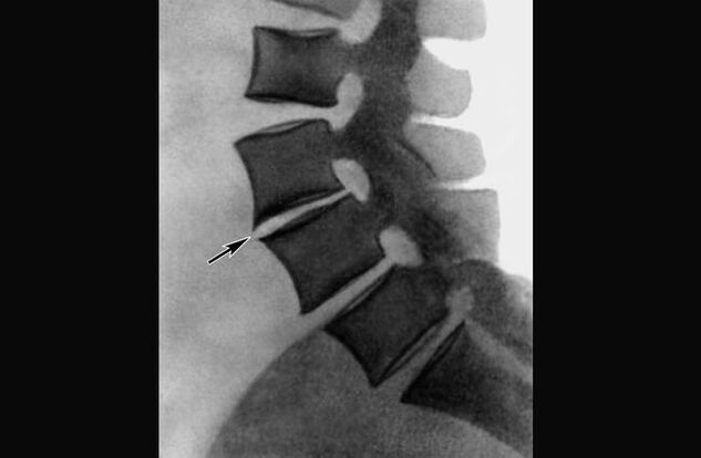 Bayyanar osteochondrosis na kashin baya na thoracic akan rediyo