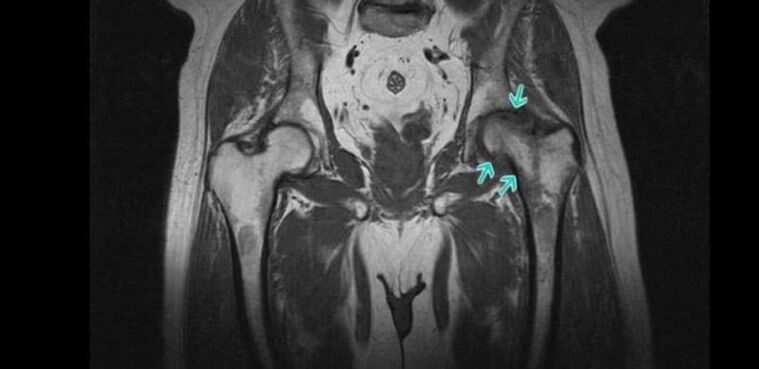 Degenerative-dystrophic canje-canje a cikin haɗin gwiwa na hip akan MRI