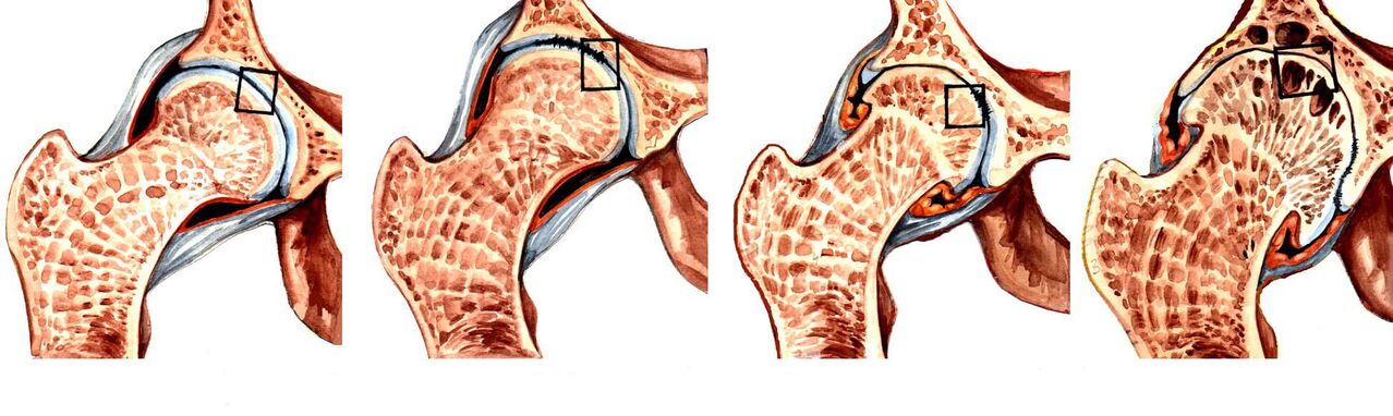 Digiri na deforming coxarthrosis