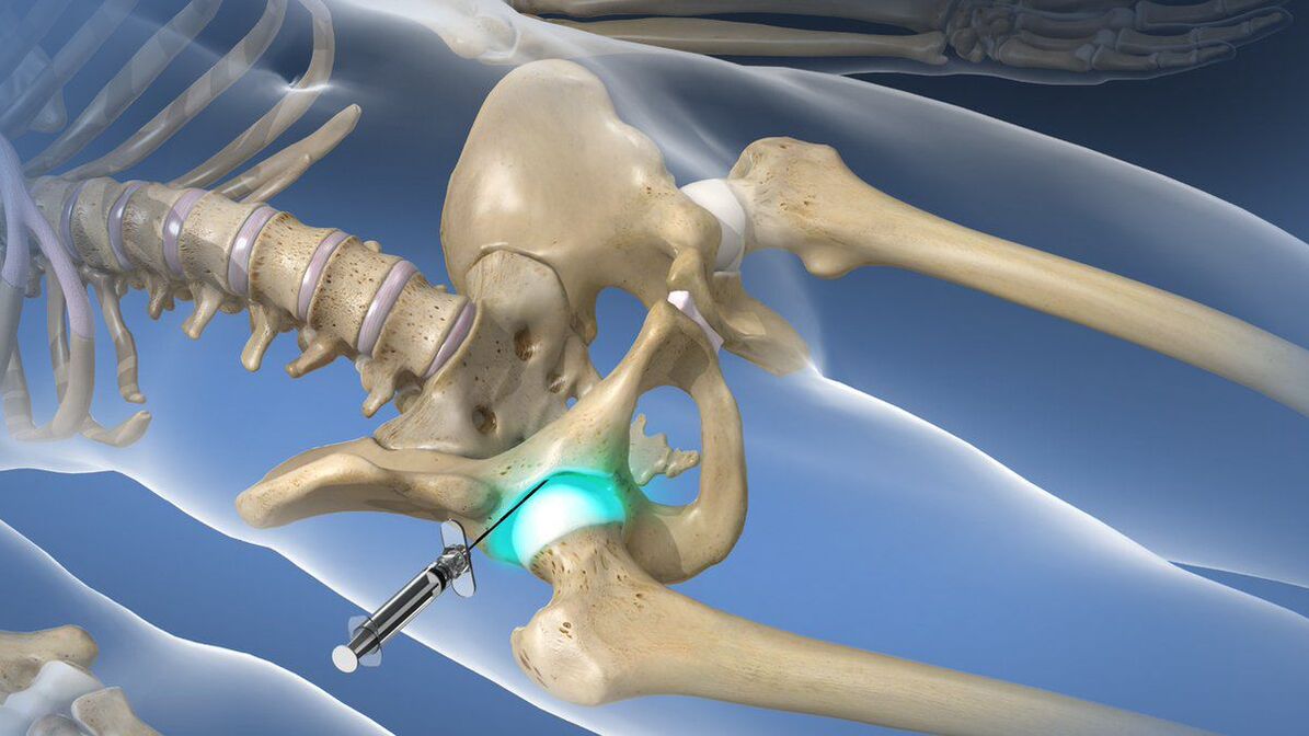 Intra-articular blockage don kawar da ciwo mai tsanani a cikin coxarthrosis