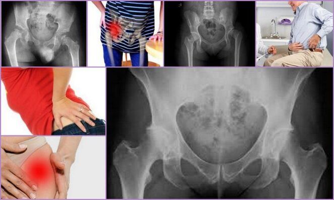 Raɗaɗi da ƙayyadaddun motsi sune manyan alamun cututtukan osteoarthritis na hip