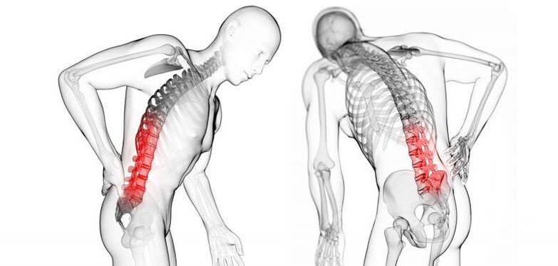 rikitarwa tare da osteochondrosis na mahaifa